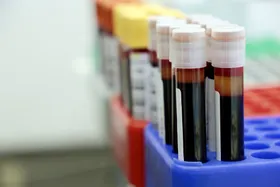 Understanding Your Blood Test Lab Results